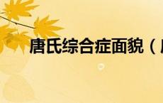 唐氏综合症面貌（唐氏综合症国际脸）