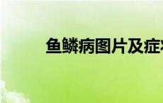 鱼鳞病图片及症状（鱼鳞病图片）